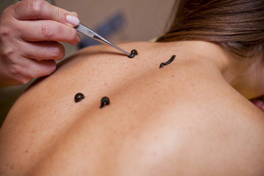 Гирудотерапия в санатории - фотография